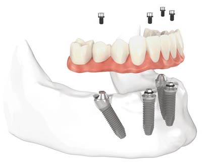 All on 4 dental implant