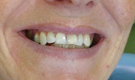 Teeth before placement of veneers