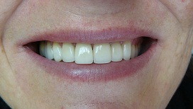 Teeth after aesthetic treatment