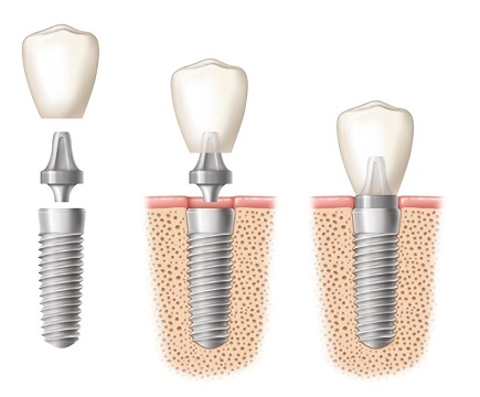 dental implants in hungary