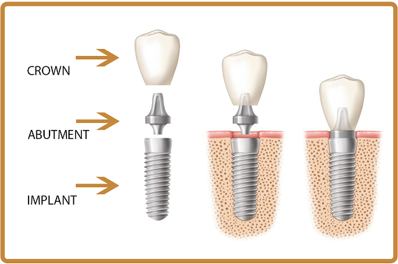 dental implant cheaper in budapest