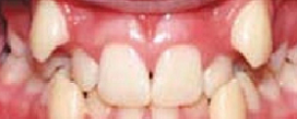 Teeth that need to be aligned with crowns.