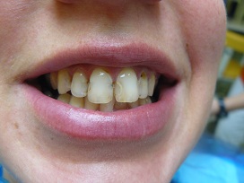 Teeth in need for treatment for a beautiful smile
