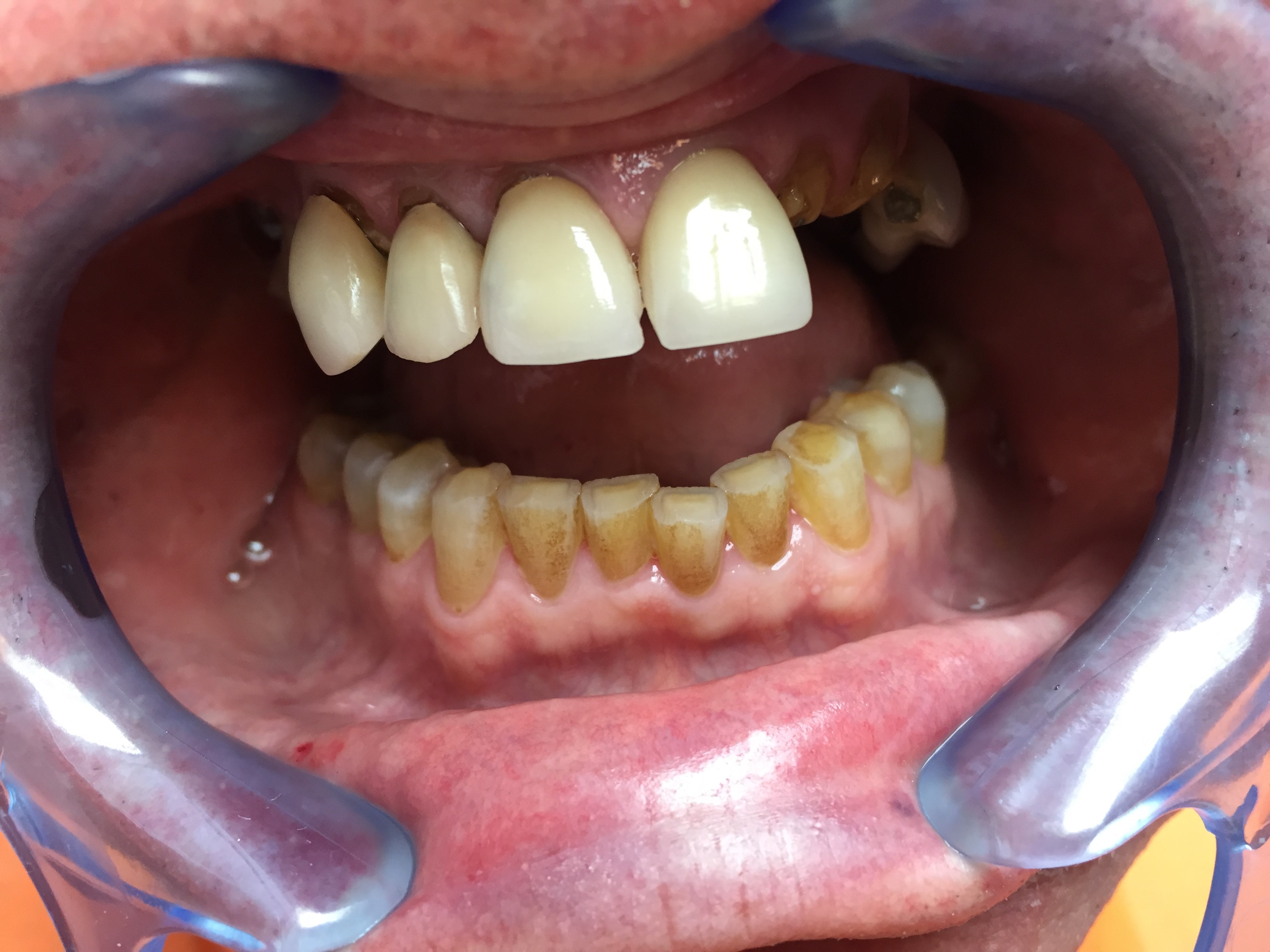 Tooth gap waiting for treatment