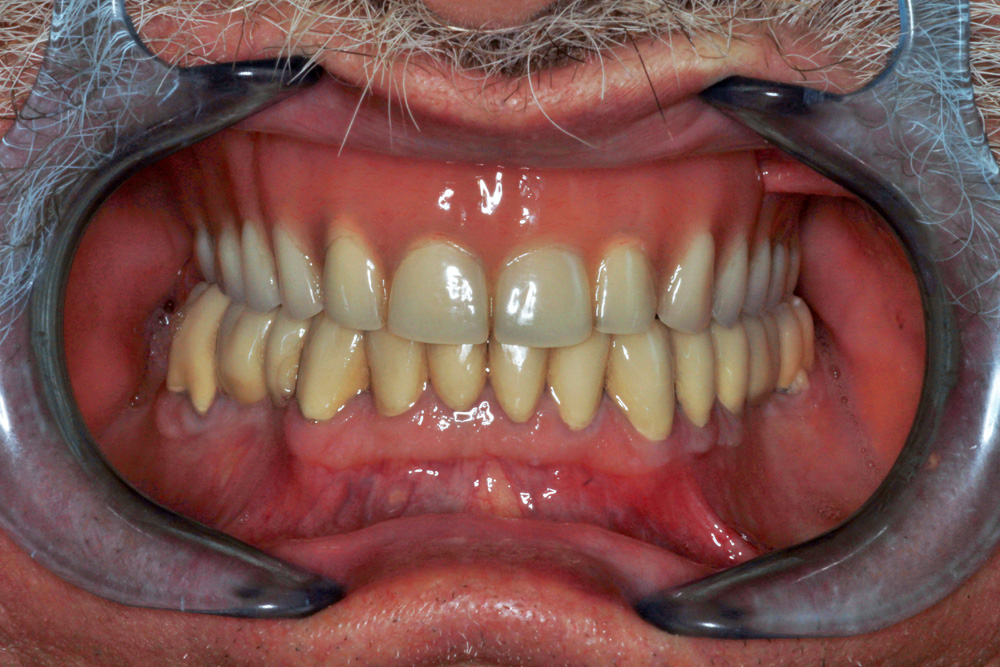 Teeth with crowns right after treatment