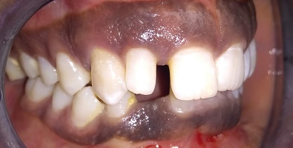 Teeth before aesthetic treatment