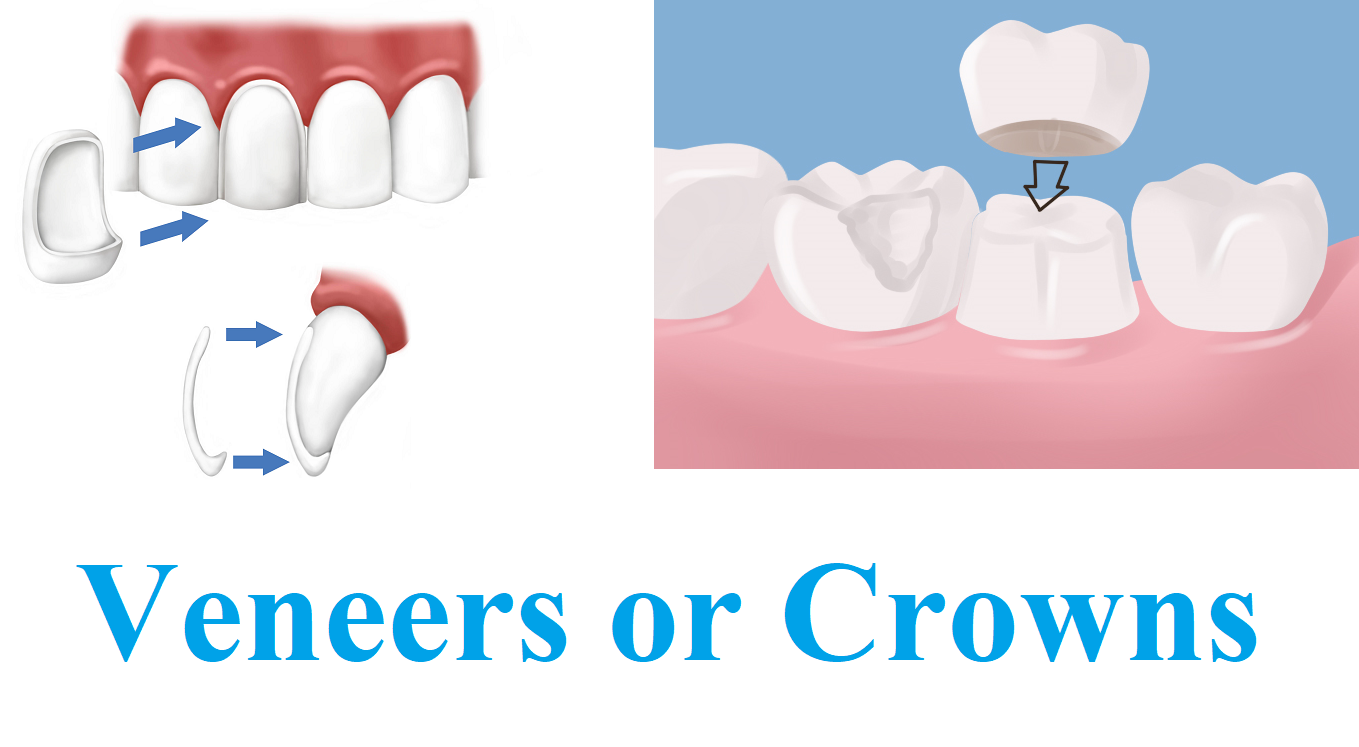an image of dental crowns and veneers