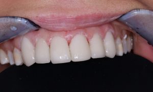 Photo of teeth after aesthetic treatment with veneers in Hungary