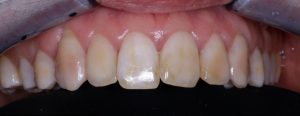 photo of teeth before aesthetic treatment