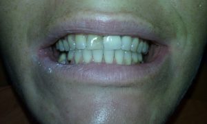 Photo of teeth before aesthetic treatment