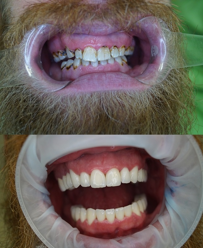 Teeth before and after CAD/CAM zirconium crown treatment in Budapest