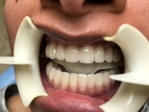 Porcelain fused to metal All-on-4 teeth
