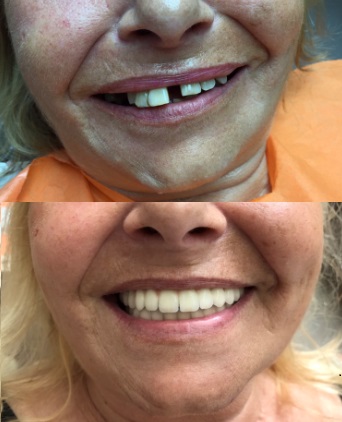 Before-after images of All-on-6 treatment in Hungary