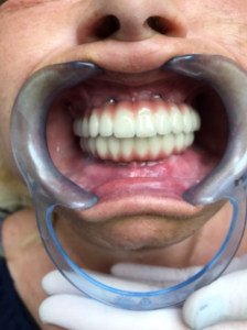 A new smile after All-on-6 treatment