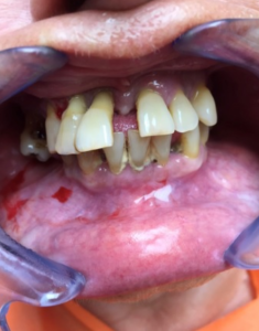 Teeth before extractions, preparation for All-on-6