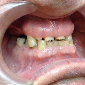 Teeth before treatment