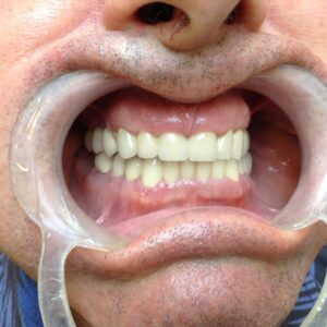 Teeth after having porcelain fused to metal crowns