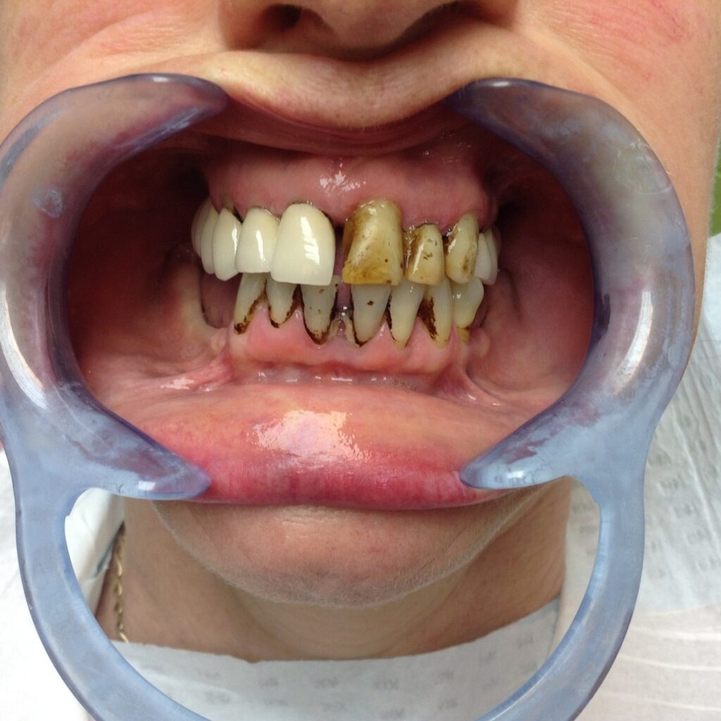 Teeth before treatment