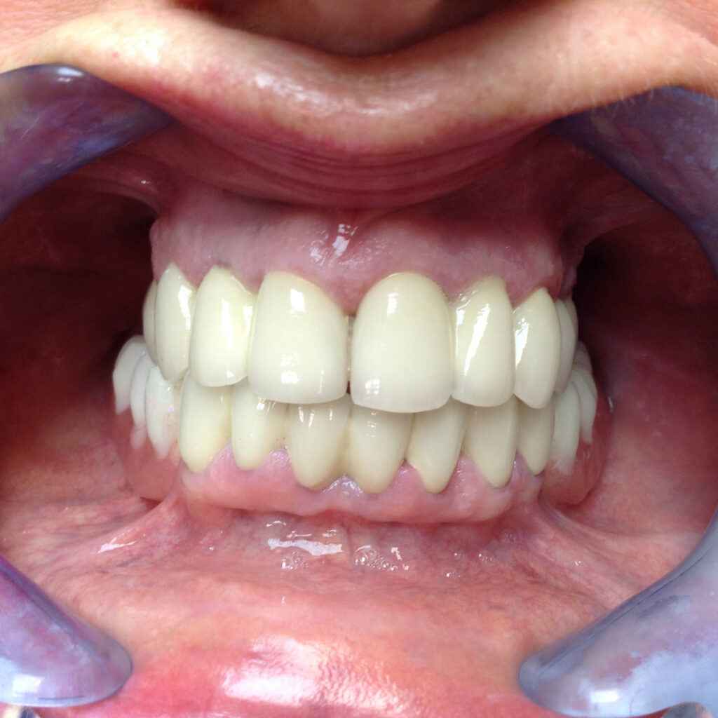 Teeth after having porcelain fused to metal crowns