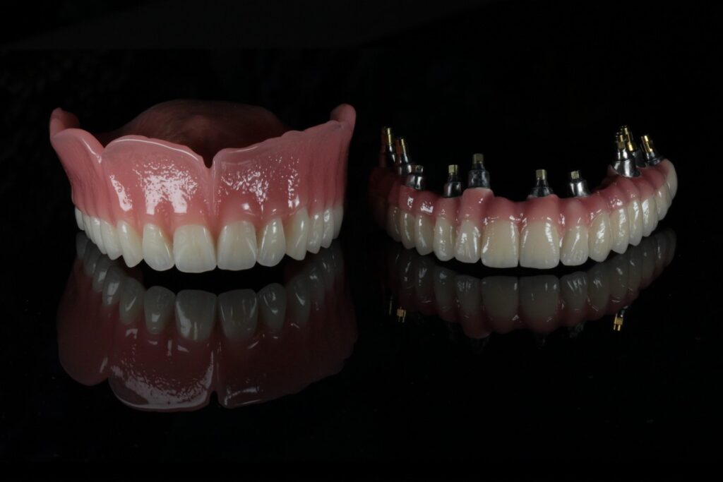 All-on complete bridge vs traditional removable denture