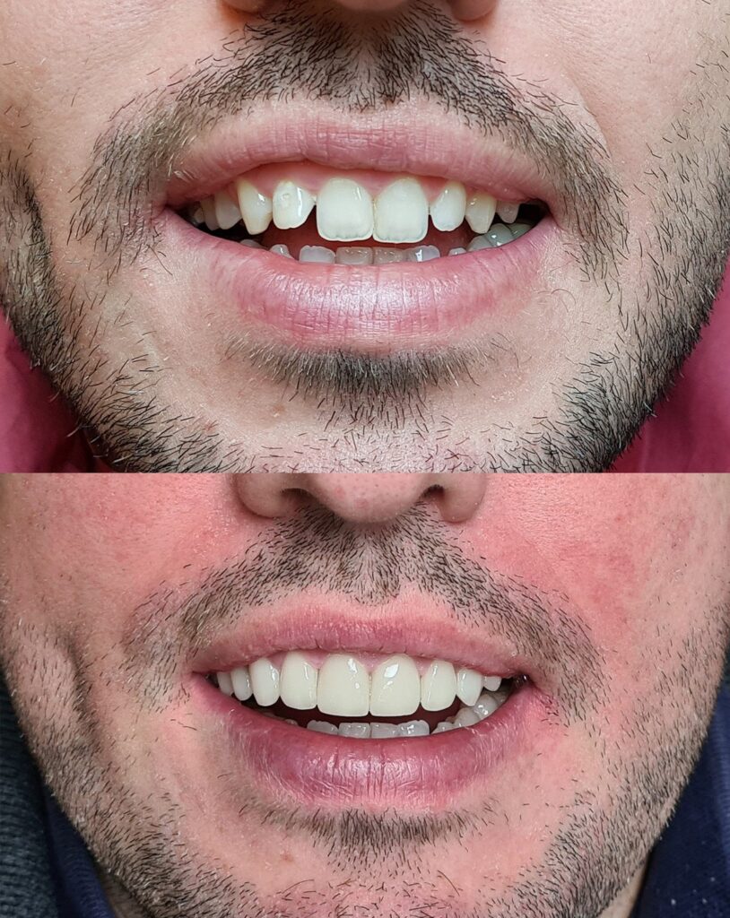Before and after veneer treatment