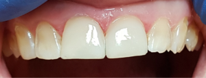 Teeth after veneer treatment