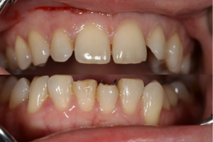 Front teeth before aesthetic treatment