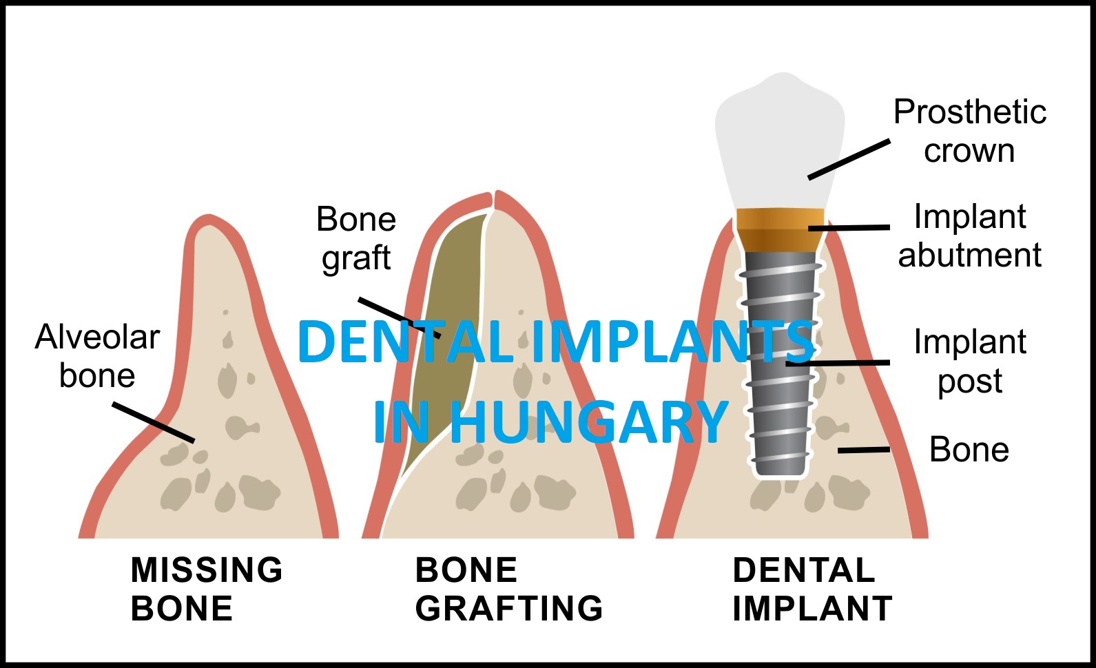bone graft and dental implant illustration