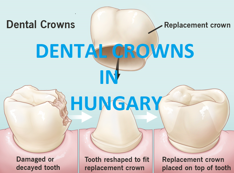 the quick process of making dental crowns in Hungary