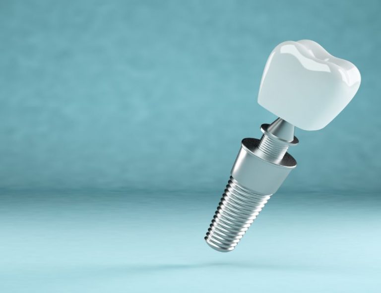 Alpha Bio Implant vs Straumann Dentaltreatment.eu