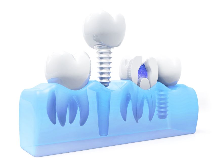 Dental implants in Budapest 