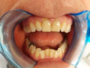 Teeth before placement of E-max Veneers