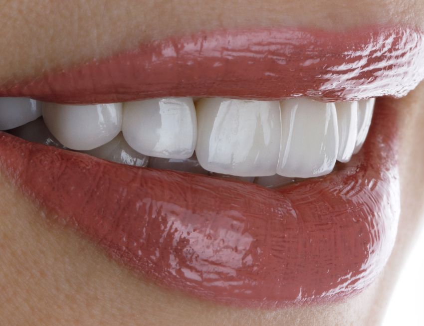 Perfect smile with dental veneers
