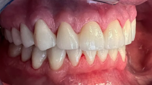 Teeth with zirconium crowns after cosmetic treatment