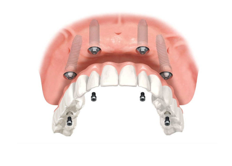 all-on-4 full denture solution after extractions
