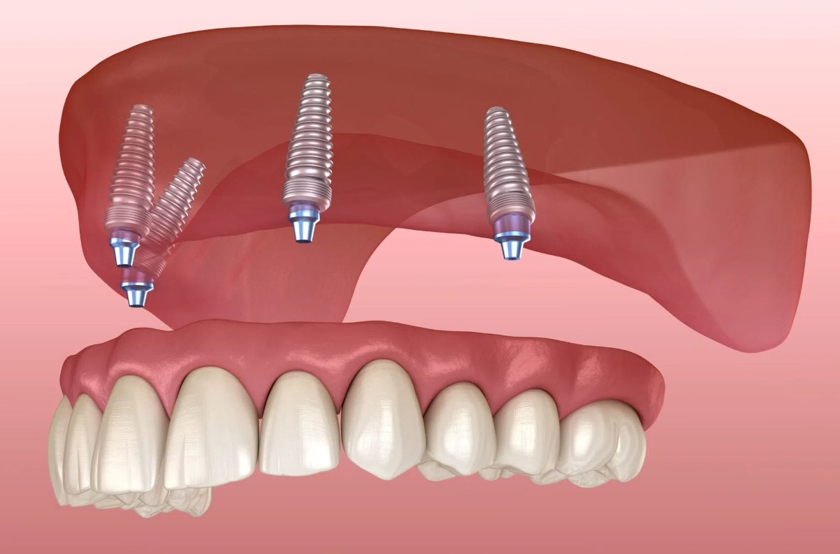 Affordable dentures and implants in Budapest - prices in the article