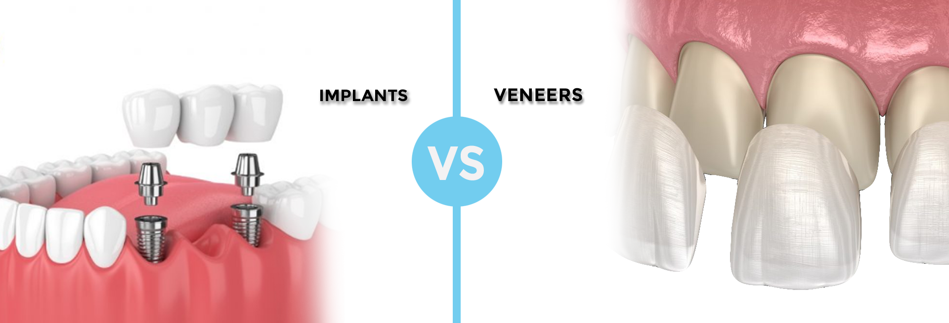The image of dental implants and veneers