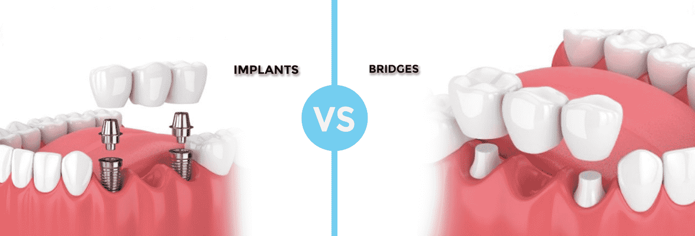 Image of implants vs. bridges