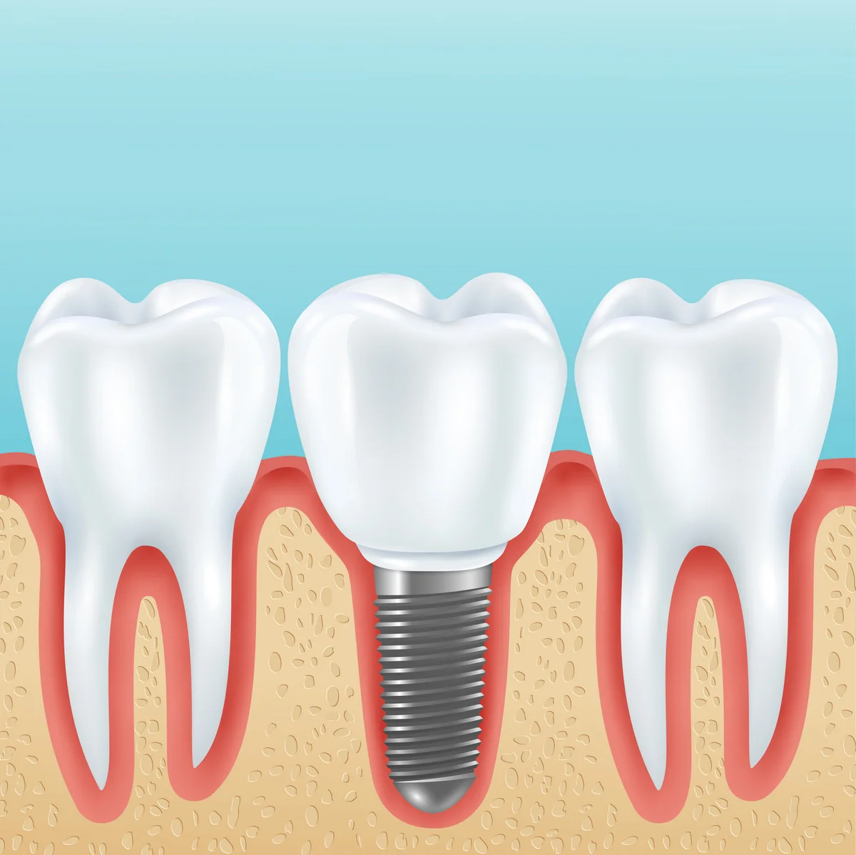 Dental implant aftercare
