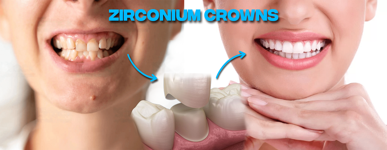 zirconium crown before and after