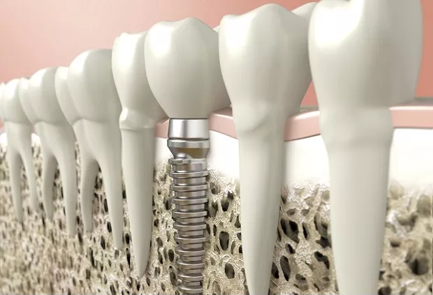 dental implant treatments in Hungary