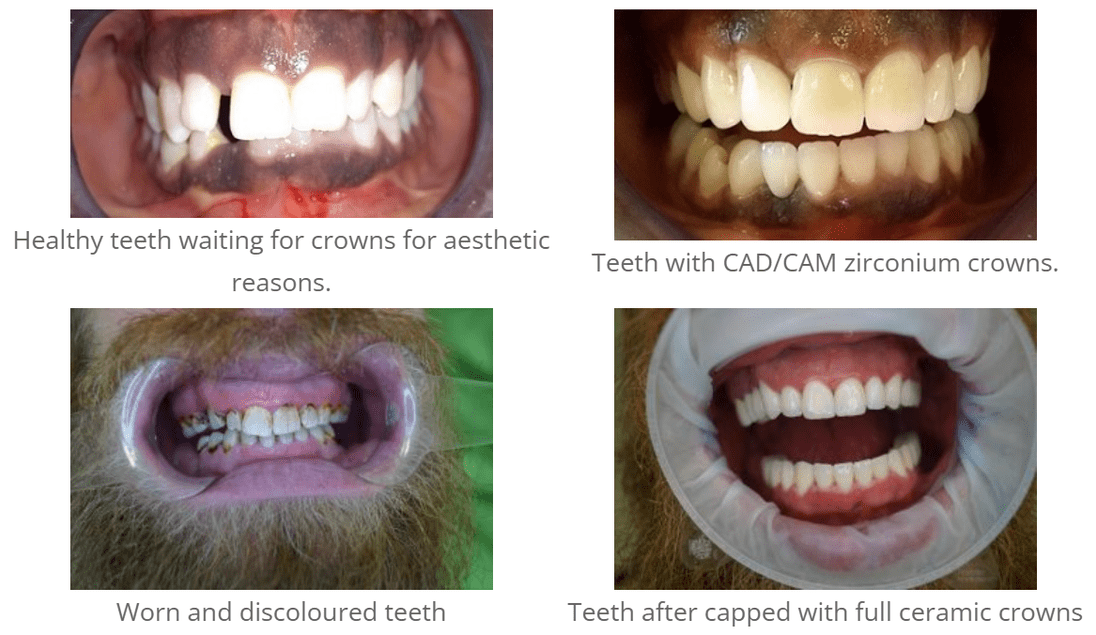 teeth_before_after_in_Budapest_work_of_dentist_in_Hungary