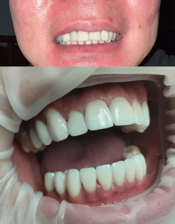 Teeth before-after Porcelain E-max veneer treatment