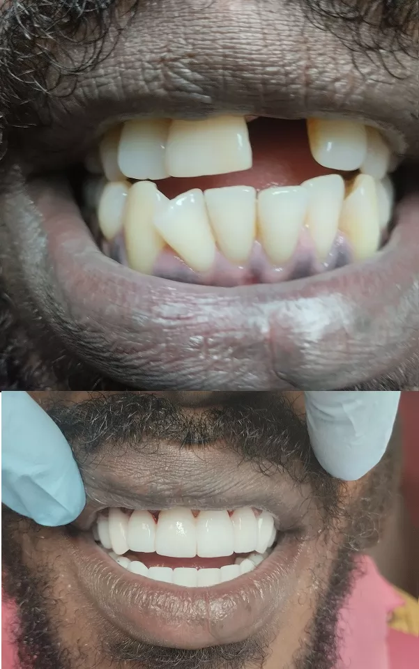 before-after-zirconium-crowns-in-Budapest