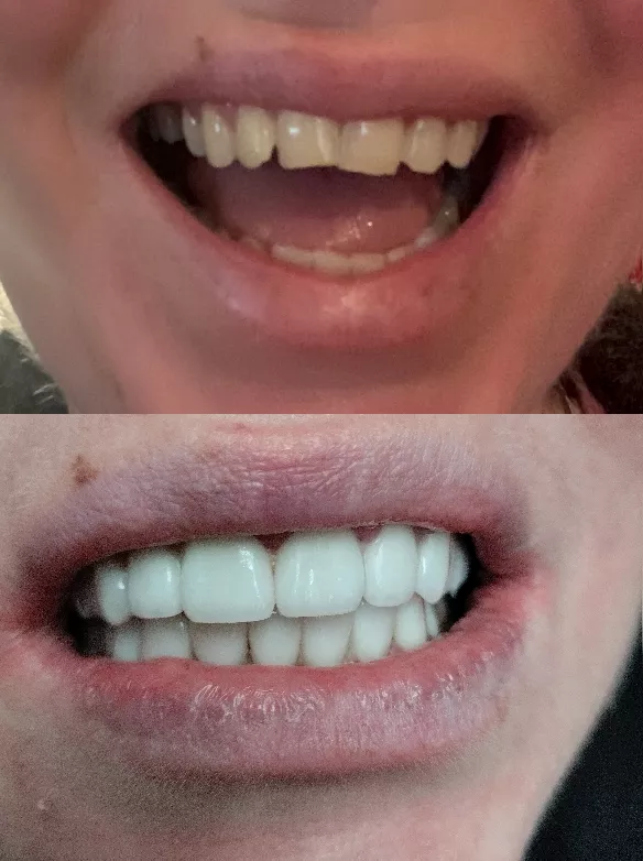 teeth_before_after_zirconium_crowns_budapest