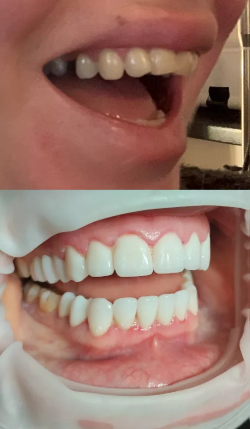 teeth_before_after_zirconium_crowns_budapest