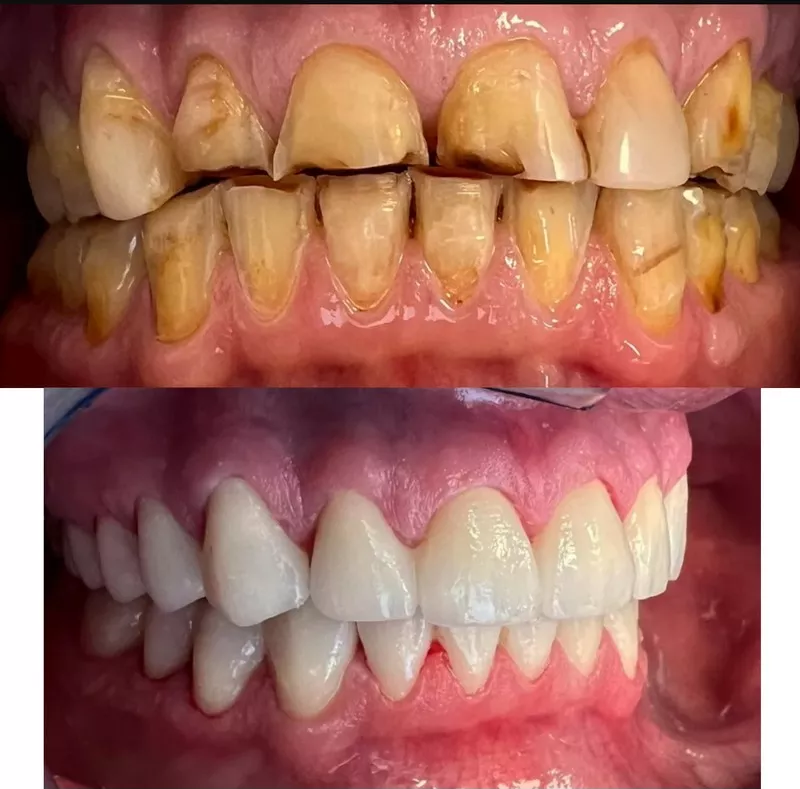 Zirconia-crown-before-after-image-in-Budapest