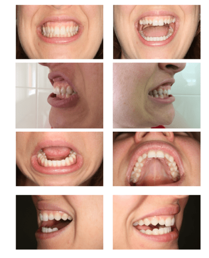 sample images for smile makeover treatment plans - the way to a perfect hollywood smile