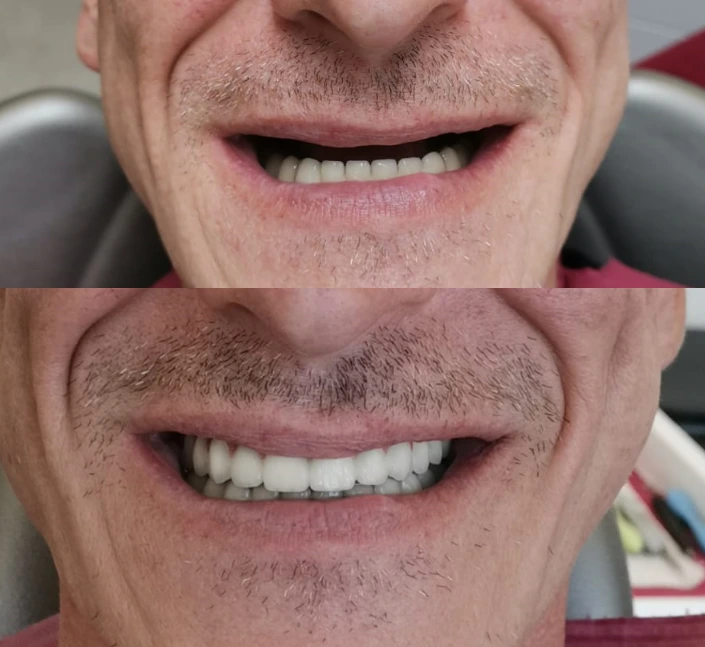 Toothless upper jaw before - after zirconium all-on-6