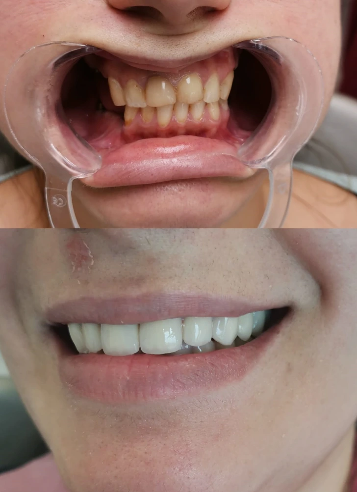 teeth_before_after_zirconium_crowns_budapest
